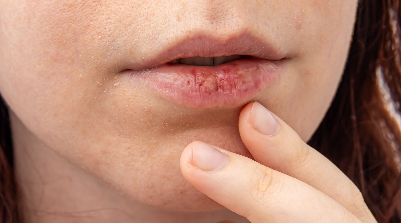 Trockene Lippen und Zunge, Mundtrockenheit im Frühling, Nahaufnahme