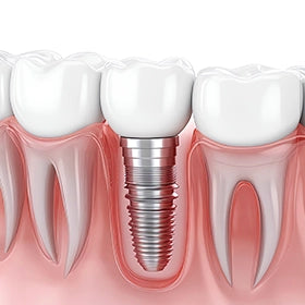 cuidado de implantes