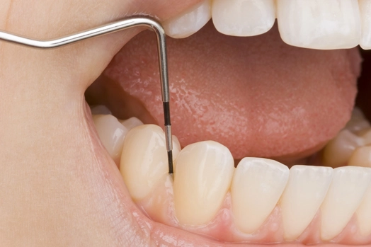 Was sind Zahnfleischtaschen und wie kann ich sie reinigen?